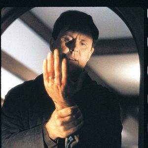 Foto Síndrome de Caim