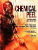 Pôster de Chemical Peel