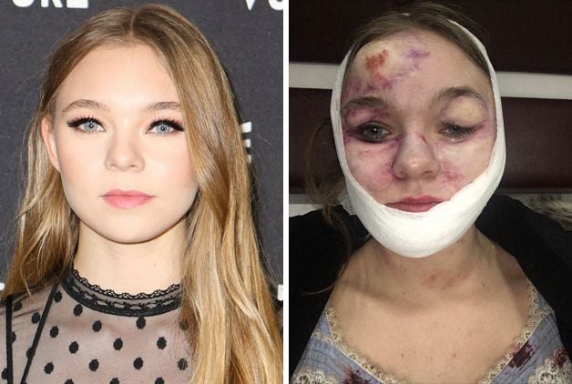 Atriz Taylor Hickson processa produtores de Ghostland após ter o rosto  desfigurado durante as filmagens - AdoroCinema